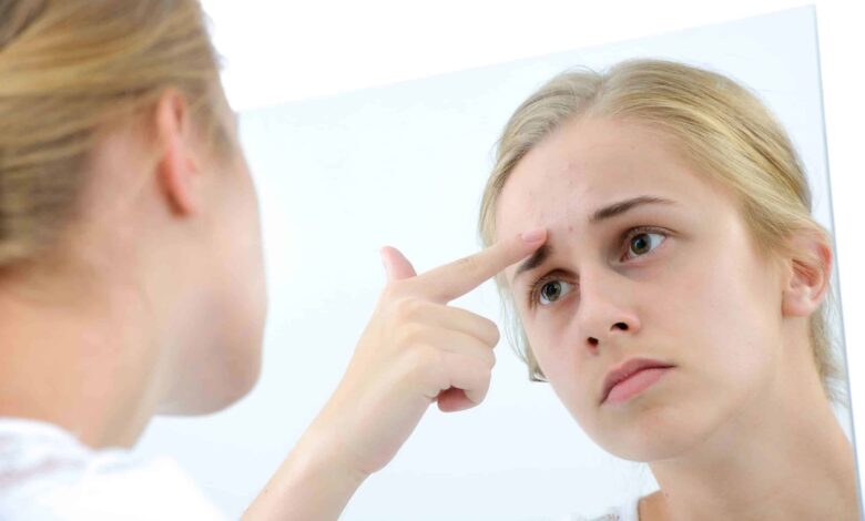 روش های درمان جوش صورت