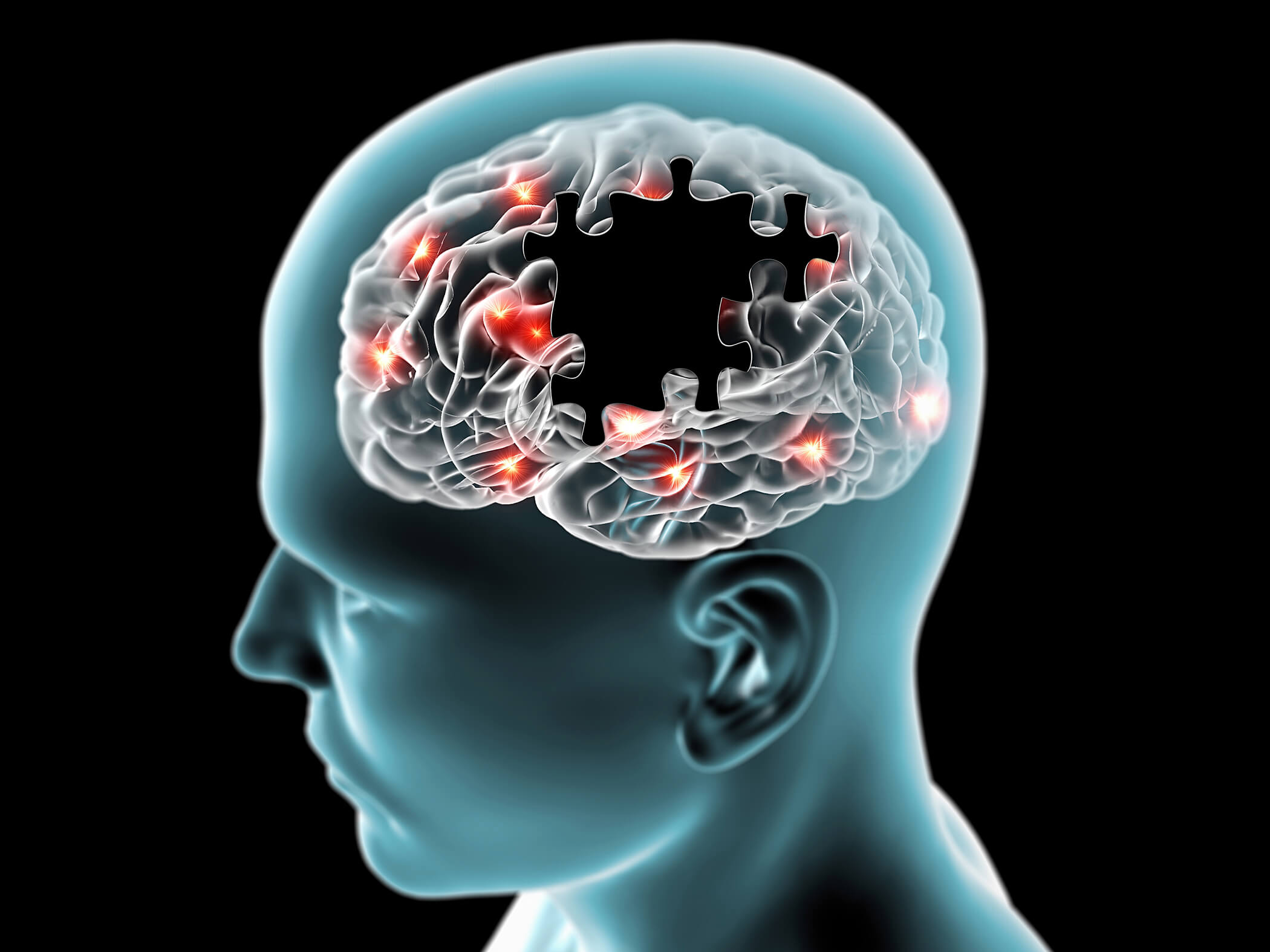 Alzheimer آلزایمر