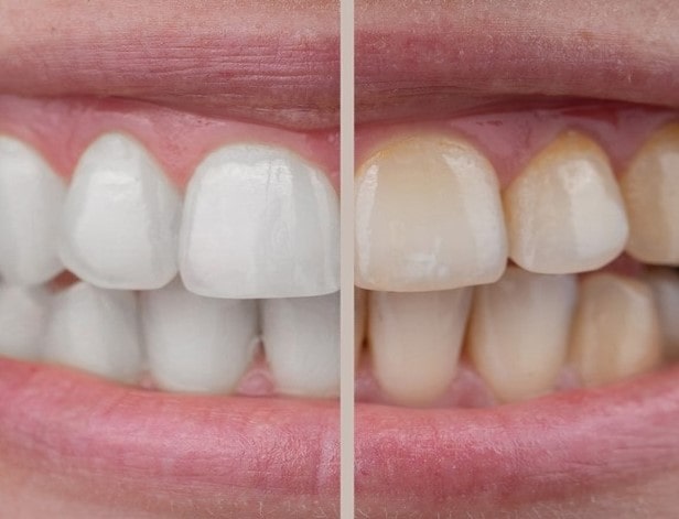 ماندگاری و دوام بلیچینگ دندان چقدر است؟