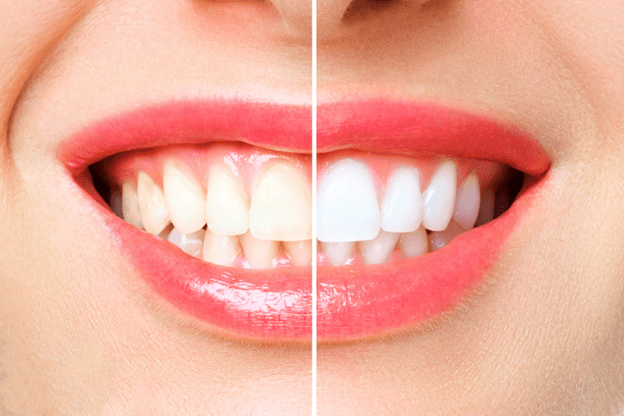 ماندگاری و دوام بلیچینگ دندان چقدر است؟