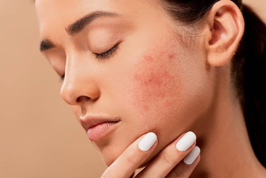 فواید آبرسان برای پوست چرب