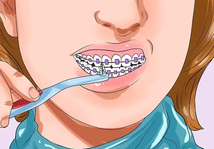 تمیز کردن دندان های ارتودنسی شده