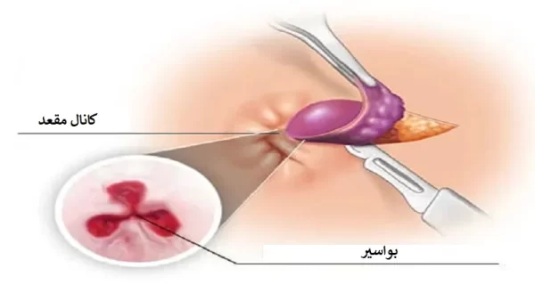 جراحی بواسیر