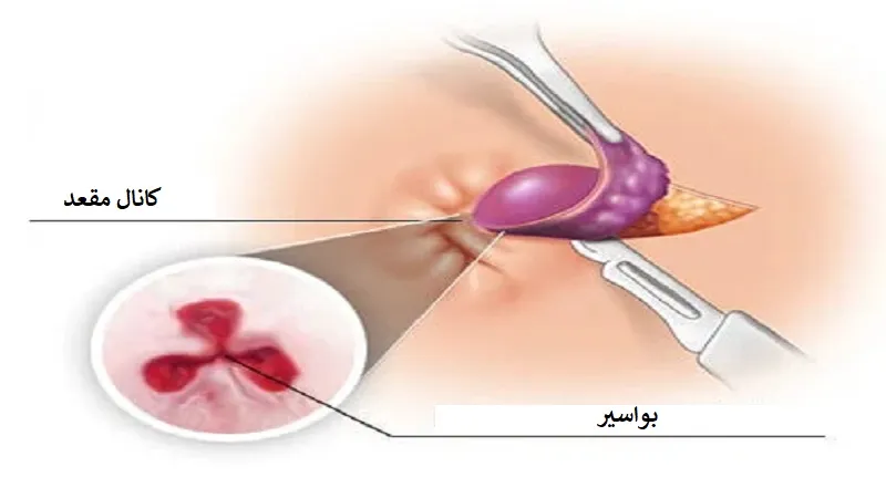 جراحی بواسیر
