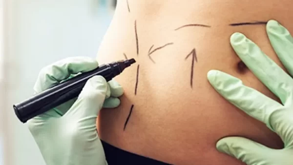 آمار تکان‌دهنده چاقی در ایران، آیا جراحی لاغری راه توقف دیابت و فشار خون است؟