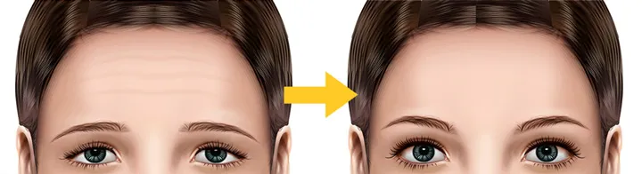 ماندگاری و مزایای لیفت ابرو و پیشانی