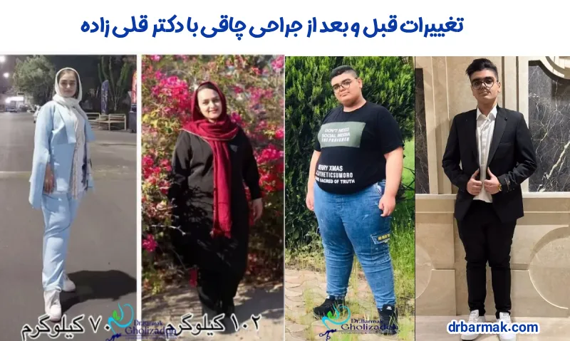 تجربه اسلیو معده از نگاه بیماران دکتر قلی زاده