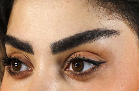 عمل لیفت شقیقه