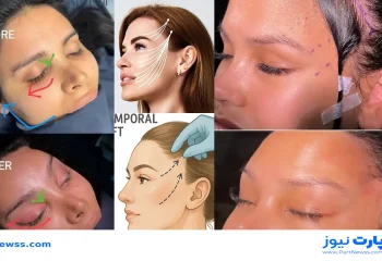 همه چیز درباره عمل لیفت شقیقه + مزایا، عوارض، ماندگاری و هزینه