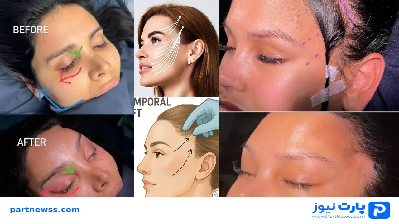 همه چیز درباره عمل لیفت شقیقه + مزایا، عوارض، ماندگاری و هزینه